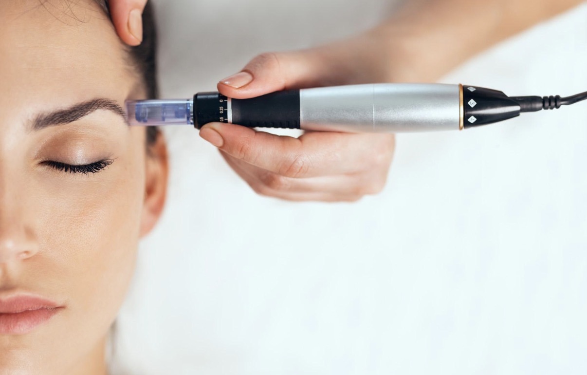Advanced Microneedling at Skin by Saif Clinic